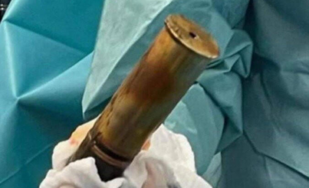 Anziano si presenta in ospedale con una bomba nel retto: si scatena il panico 