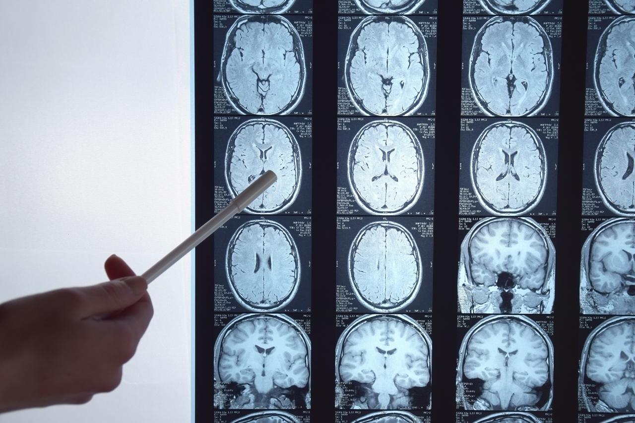 Cancro al cervello, scoperto un indice che predice la sopravvivenza
