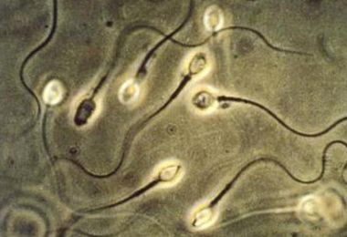Covid, effetto virus sui maschi: anche dopo 3 mesi meno spermatozoi e più lenti